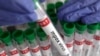 Une éprouvette étiquetée « mpox virus - positif » est tenue par un travailleur de la santé, le 20 août 2024. Reuters / Dado Ruvic